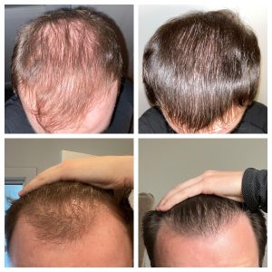 12-months-finasteride-minoxidil-microneedling-nizoral-v0-j8vncv25ru491