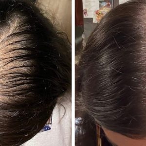 Microneedling-with-Exosomes-