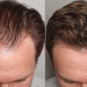 microneedling-hairloss