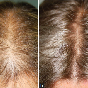 microneedling-hairloss1